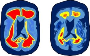 cerv_alz_aducanumab